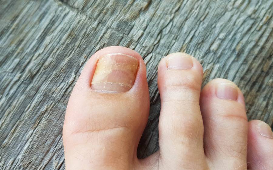 Nail Fungus: Understanding, Treating Naturally, and Preventing It